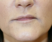 Feel Beautiful - Filler in frown lines San Diego - After Photo